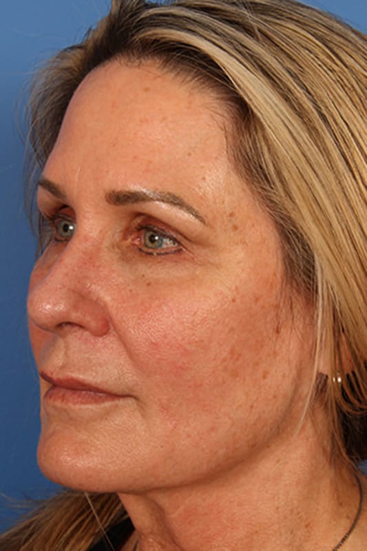 Facelift Before & After Photo