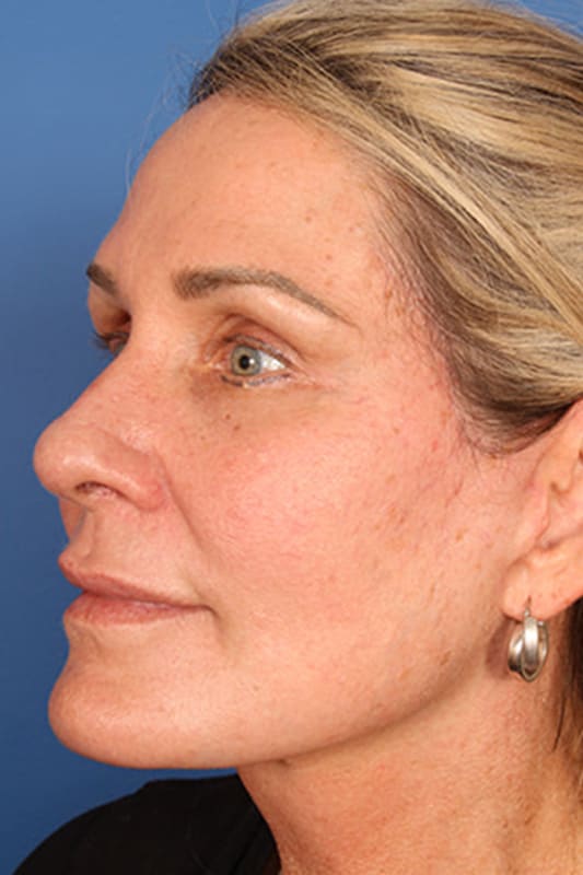 Facelift Before & After Photo