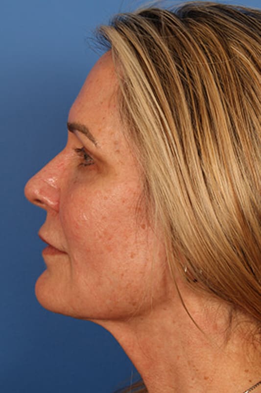 Facelift Before & After Photo