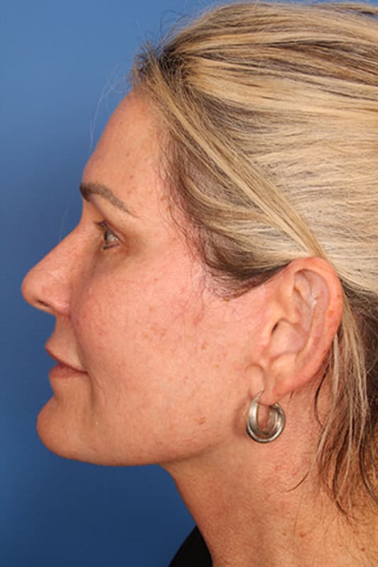 Facelift Before & After Photo