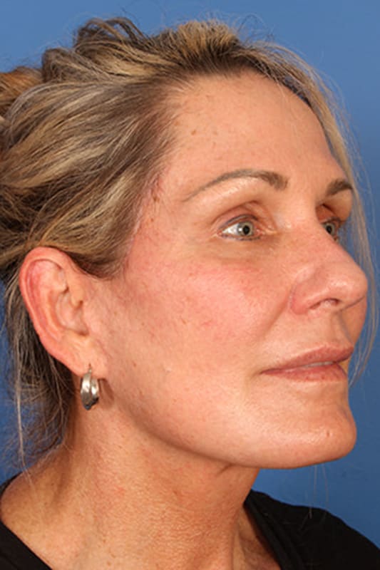 Facelift Before & After Photo