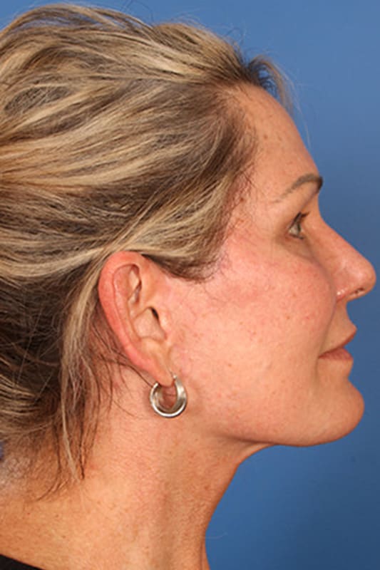 Facelift Before & After Photo