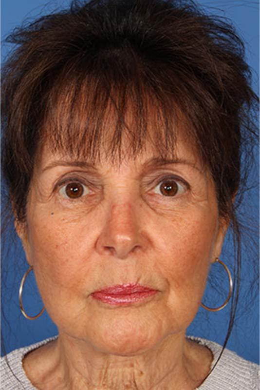 Facelift Before & After Photo