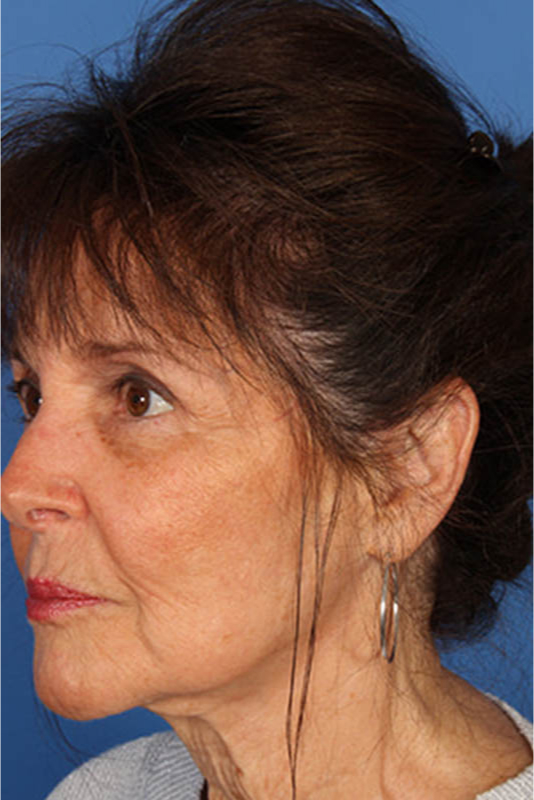 Facelift Before & After Photo