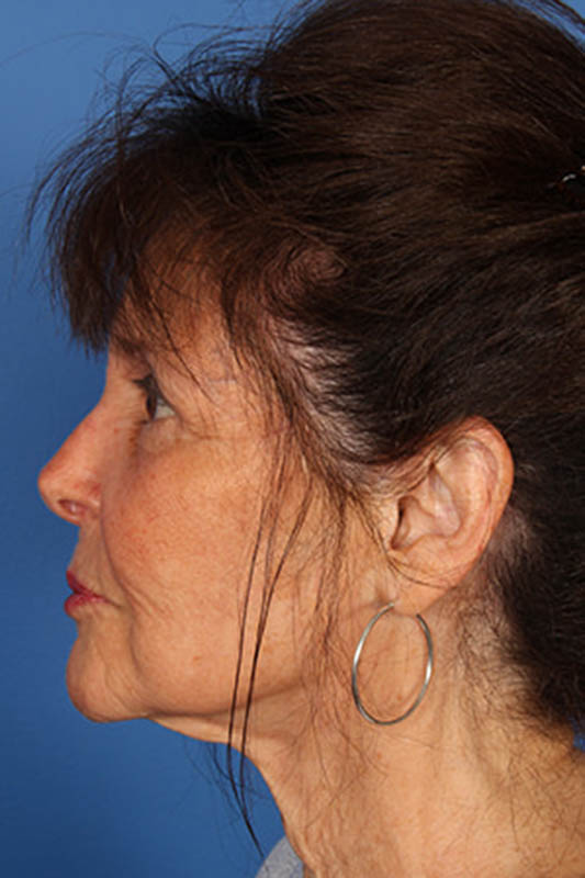 Facelift Before & After Photo