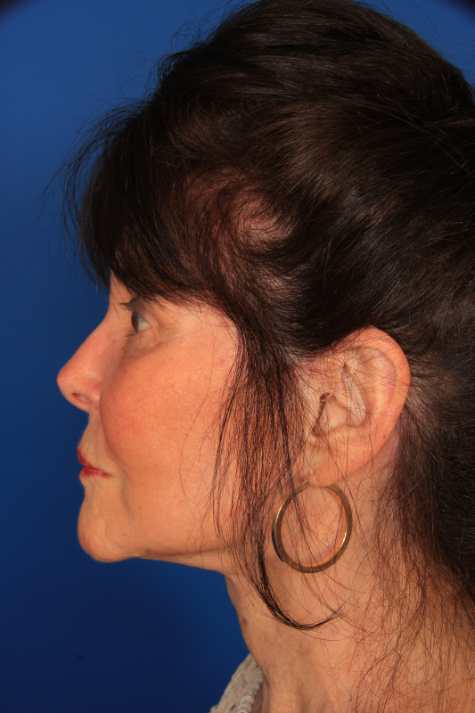 Facelift Before & After Photo