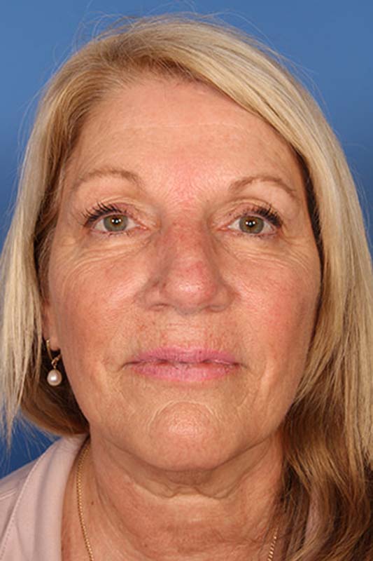 Facelift Before & After Photo