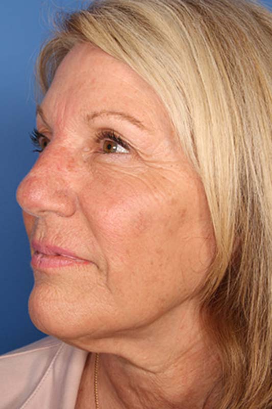 Facelift Before & After Photo