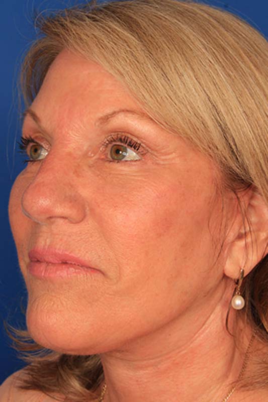 Facelift Before & After Photo