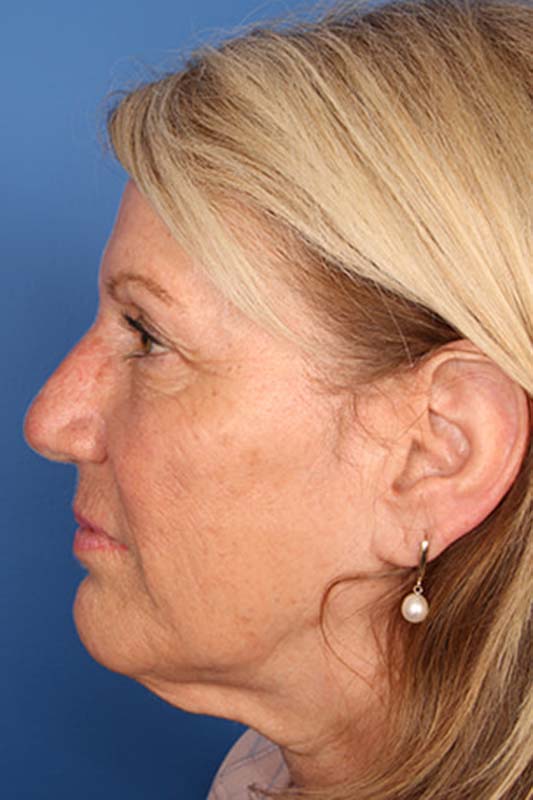 Facelift Before & After Photo