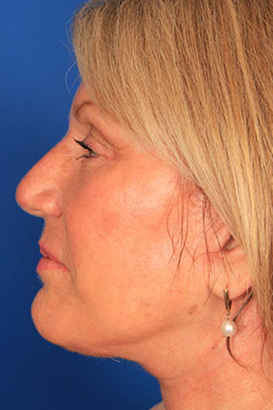 Facelift Before & After Photo