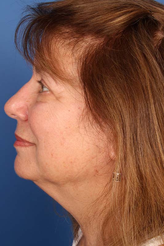 Facelift Before & After Photo