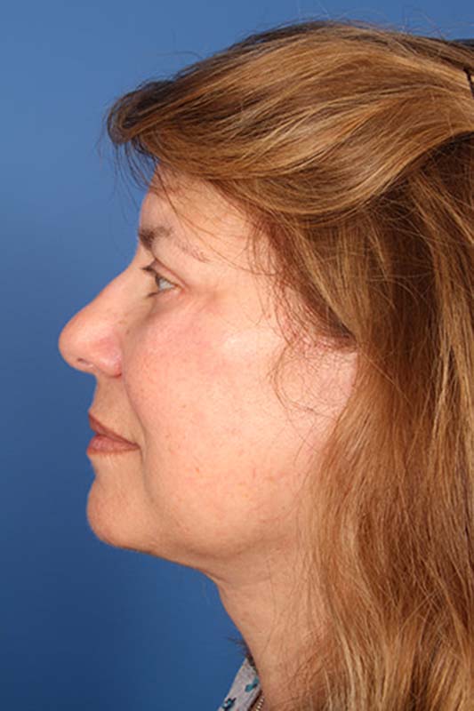 Facelift Before & After Photo