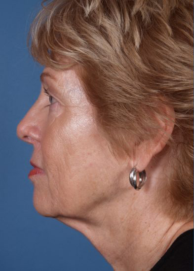 Facelift Before & After Photo