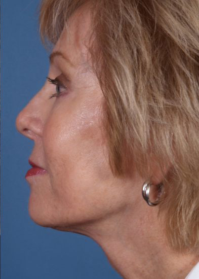 Facelift Before & After Photo