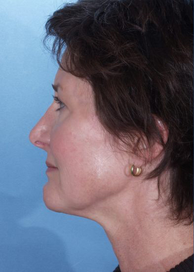 Facelift Before & After Photo