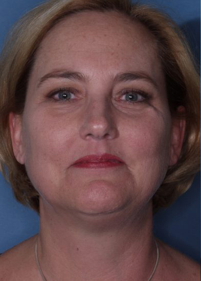 Facelift Before & After Photo