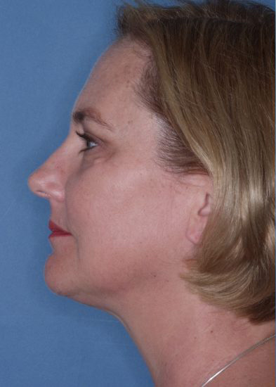 Facelift Before & After Photo