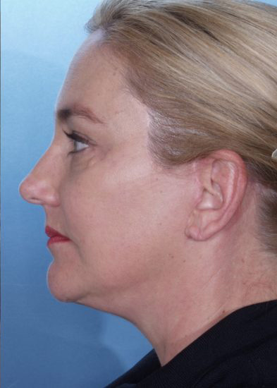 Facelift Before & After Photo