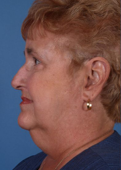 Facelift Before & After Photo