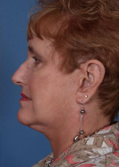 Facelift Before & After Photo