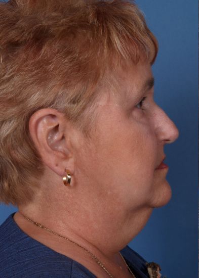 Facelift Before & After Photo