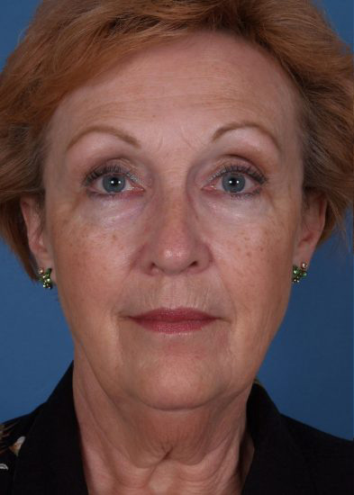 Facelift Before & After Photo