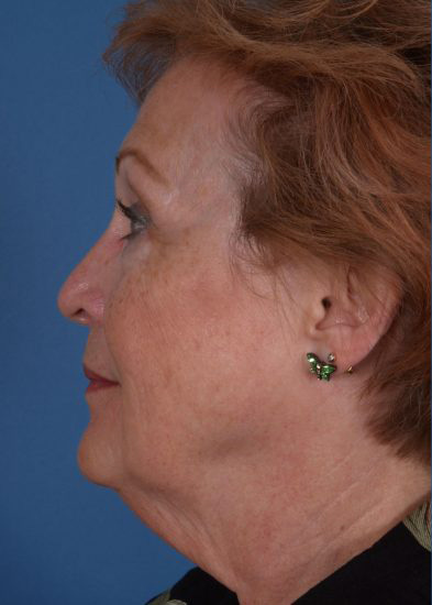 Facelift Before & After Photo