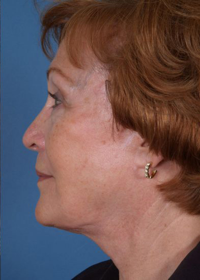 Facelift Before & After Photo