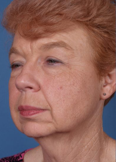Facelift Before & After Photo