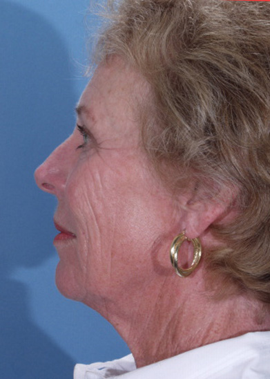 Facelift Before & After Photo