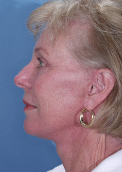 Facelift Before & After Photo