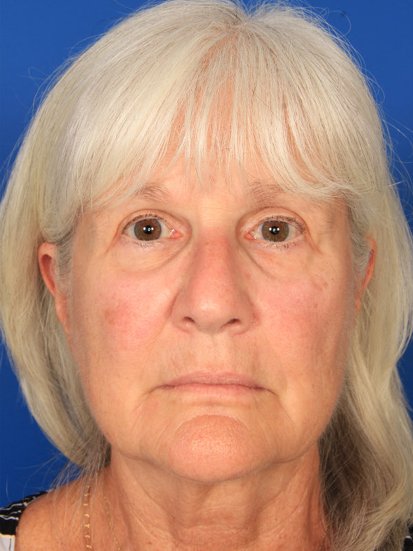 Lower Blepharoplasty Before & After Photo