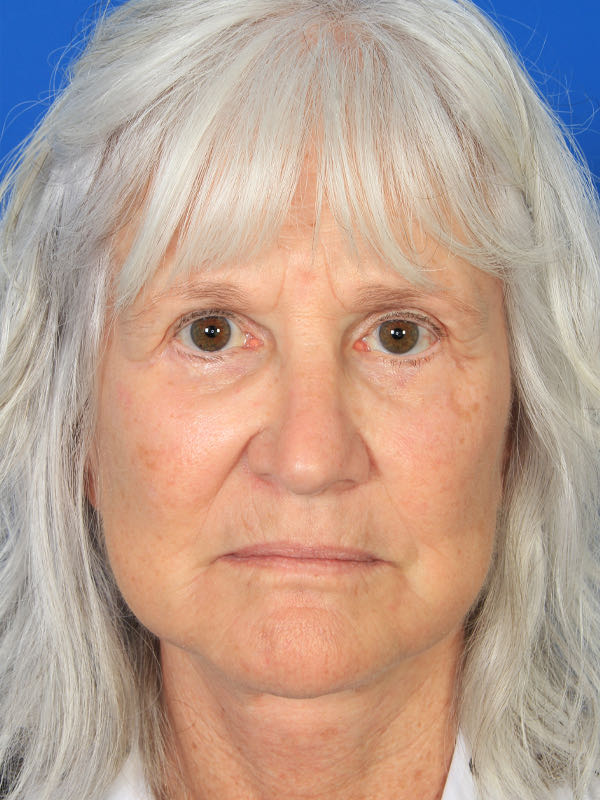 Lower Blepharoplasty Before & After Photo
