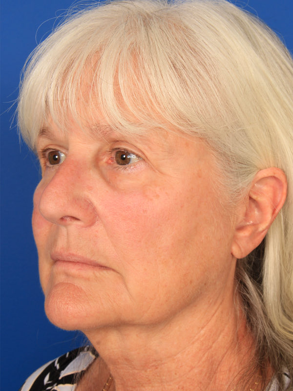 Lower Blepharoplasty Before & After Photo