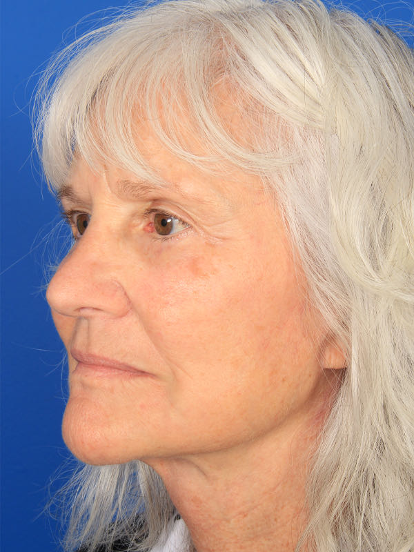 Lower Blepharoplasty Before & After Photo