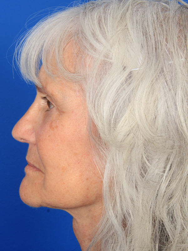 Lower Blepharoplasty Before & After Photo