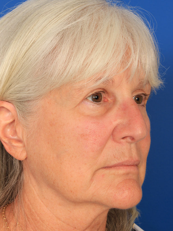 Lower Blepharoplasty Before & After Photo