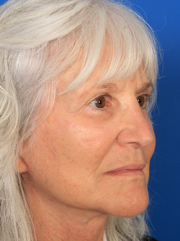 Lower Blepharoplasty Before & After Photo
