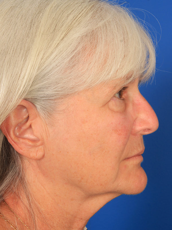 Lower Blepharoplasty Before & After Photo