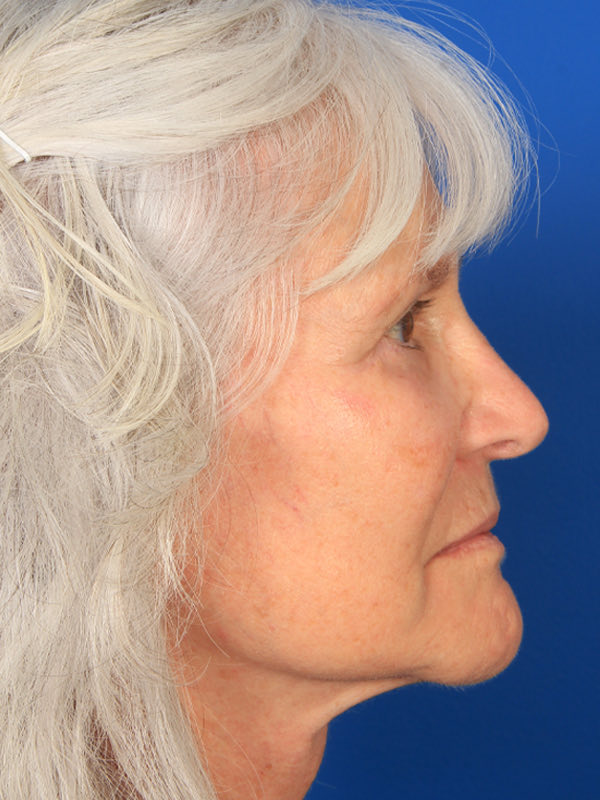 Lower Blepharoplasty Before & After Photo
