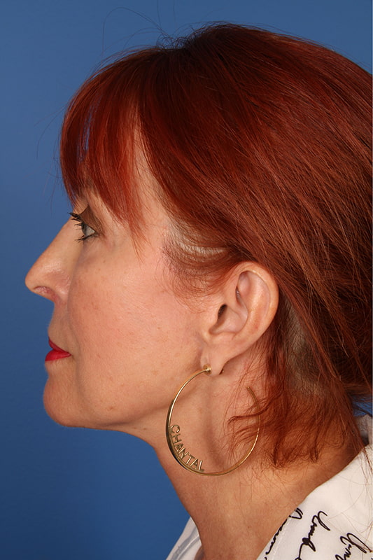 Neck Lift Before & After Photo