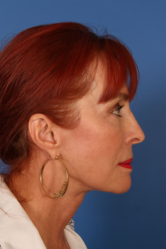 Neck Lift Before & After Photo