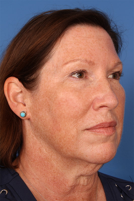 Neck Lift Before & After Photo