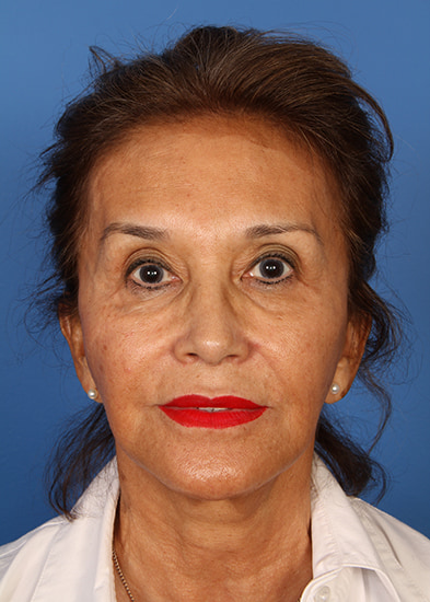 Neck lift gallery Before & After Image