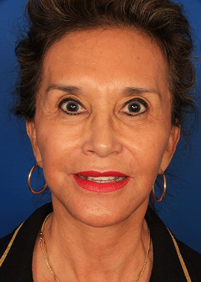 Neck lift gallery Before & After Image