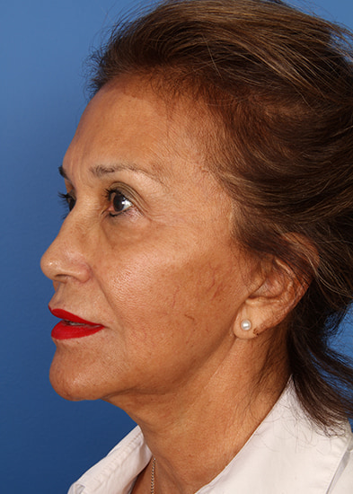 Neck lift gallery Before & After Image