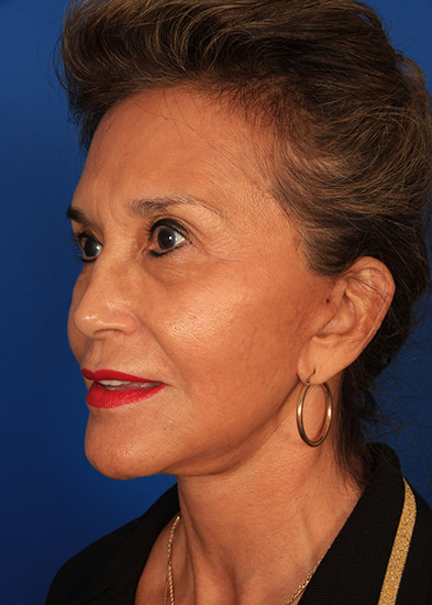Neck lift gallery Before & After Image