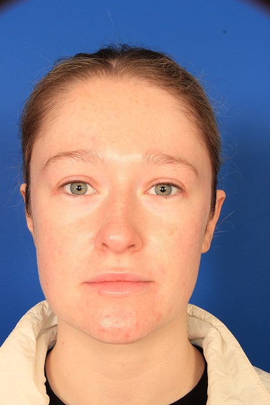 Otoplasty Before & After Photo