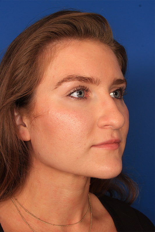 Rhinoplasty Before & After Photo